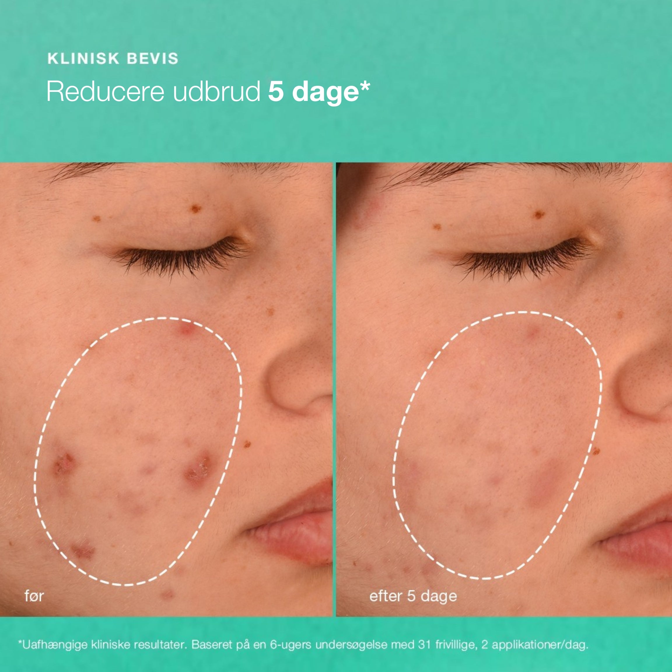 breakout biotic moisturizer
