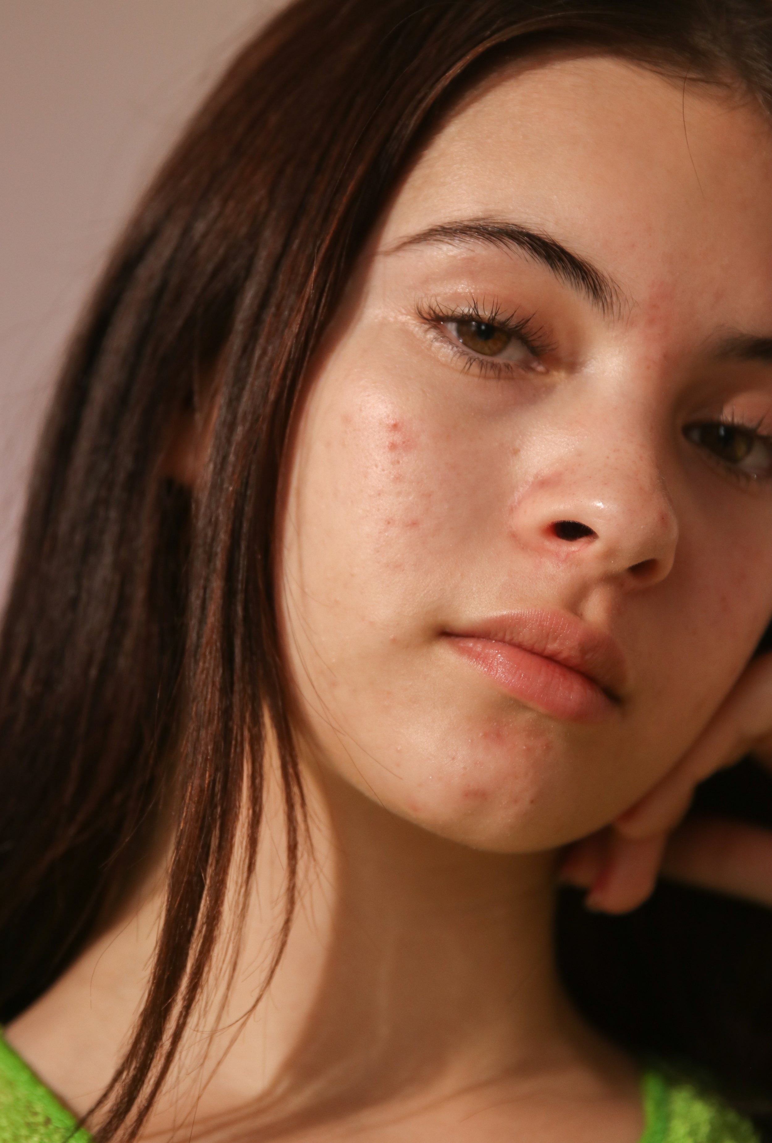 De bedste ingredienser til acne-ramt hud