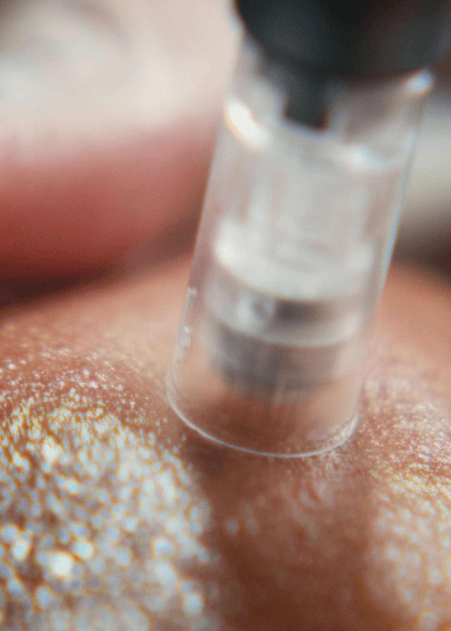 pro microneedling ansigtsbehandling